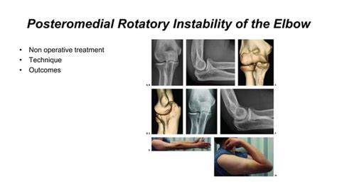 Elbow Dislocations And Terrible Triad Ppt