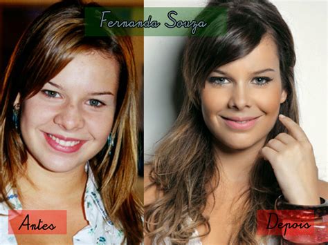 Anitta Antes E Depois Das Plasticas