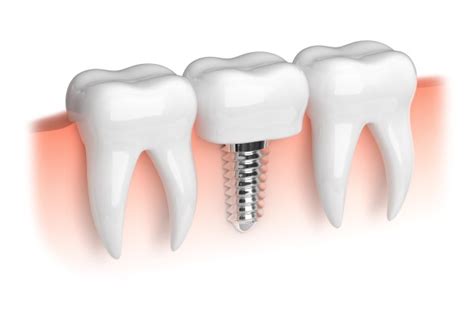 What Is Dental Implant Restoration? - About Dental Care St. George Utah