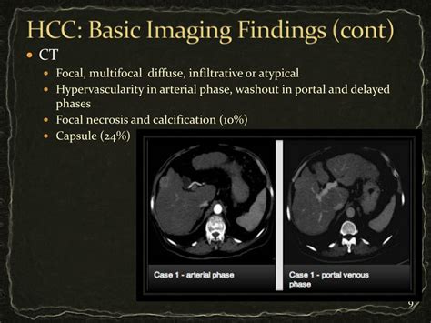 Ppt Understanding Hepatocellular Carcinoma Hcc A General Intro To