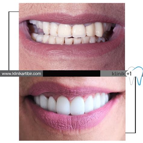 Klinik +1 Özel Diş Kliniği - Sağlıklı Dişl…