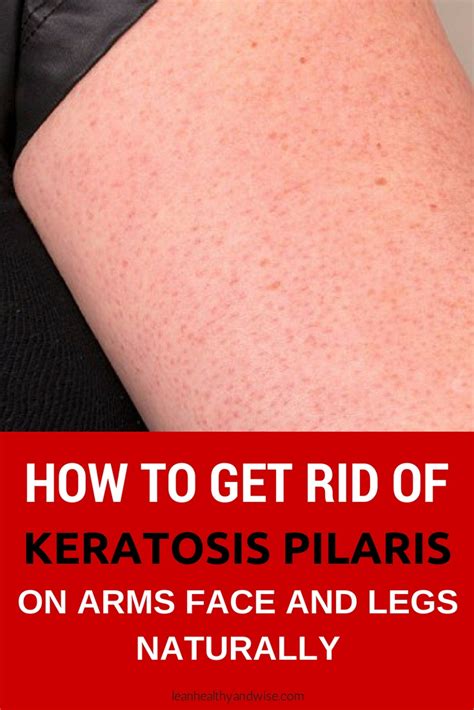 How To Get Rid Of Keratosis Pilaris On Arms Face And Legs Naturally