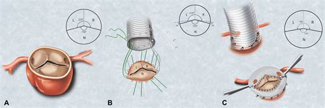 The Commissure Positioning Technique For Bicuspid Aortic