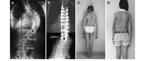 A Preoperative Standing Anteroposterior Radiograph Of A 14 8year Old