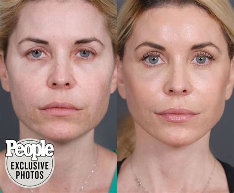 Dr Nassif Facelift Transformation Following Patients Painful Journey