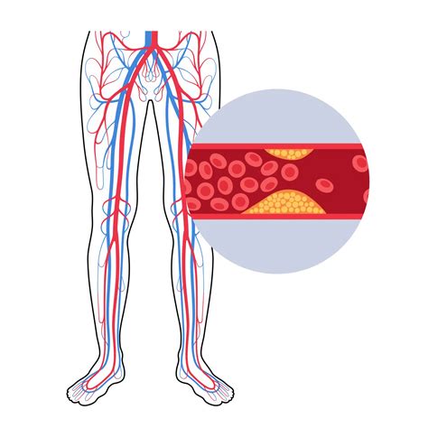 Peripheral Artery Disease Diagram