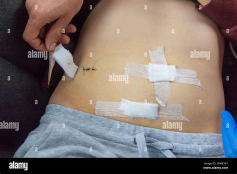 closeup fresh appendix surgery scar  res stock photography  images