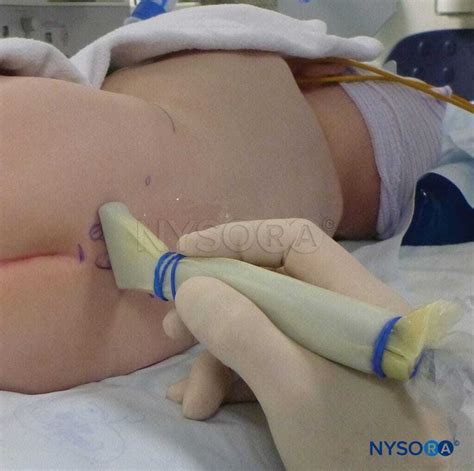 Pediatric Regional Anesthesia Update Workshop New York NYSORA