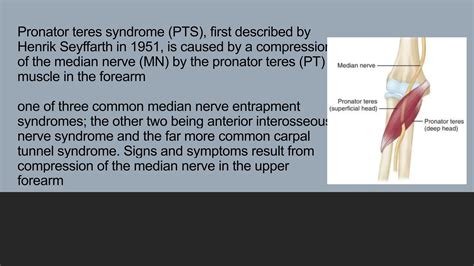 Pronator Teres Syndrome Pronator Syndrome Pptx