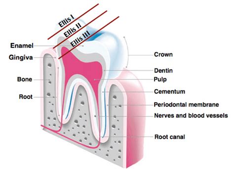 Enamel Dentin Fracture