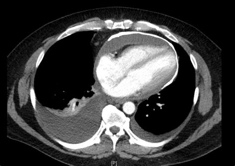 Pericardial Calcification Statpearls Ncbi Bookshelf