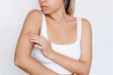 The Most Effective Ways To Get Rid Of Hives