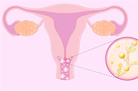 Как травами вылечить кандидоз | dyvosyl.com.ua