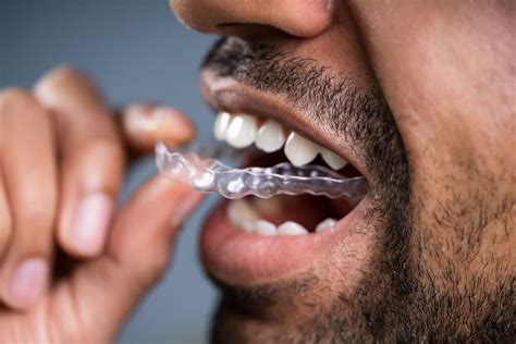 Retainers After Braces Invisalign Andover Orthodontics