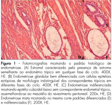 Scielo Brasil Avalia O Da Classifica O Histol Gica Da