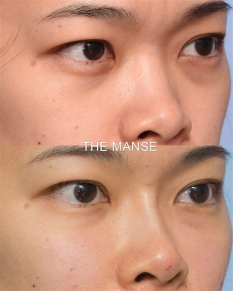 Nose Filler Non Surgical Rhinoplasty At Our Expert Sydney Clinic