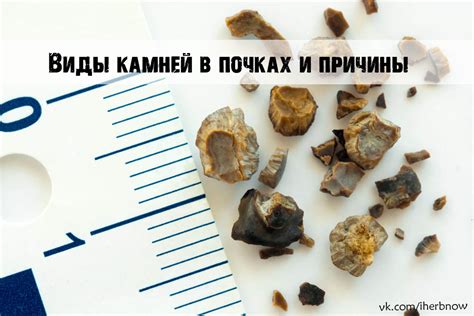 Камни в почках у женщин - причины появления