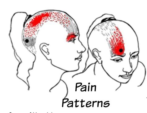 Occipital Nerve Stimulator Occipital Occipital Neuralgia Nerve Anatomy - kulturaupice