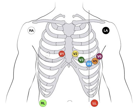 Six Lead Ekg Placement