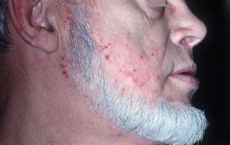 Dermatitis Herpetiformis Causes Symptoms Diagnosis And Treatment