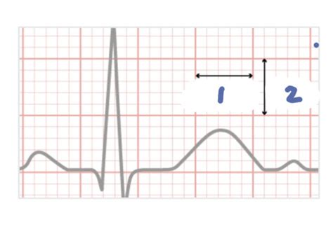 Module Ekg Flashcards Quizlet