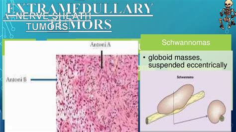 Spinal cord tumors