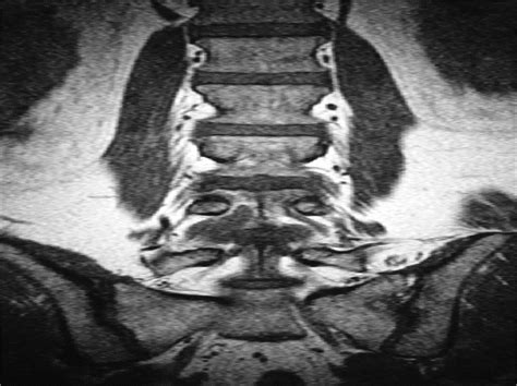 Cauda Equina Compression By Hydrogel Dural Sealant After A L Spine