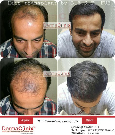 Hair Transplant Results In Chennai Before After Photos Dermaclinix