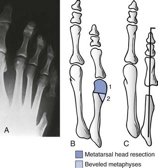 Metatarsal Head Resection