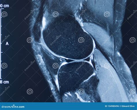 Knee Injury Mri Mcl Tear Stock Photo Image Of Human 154980496