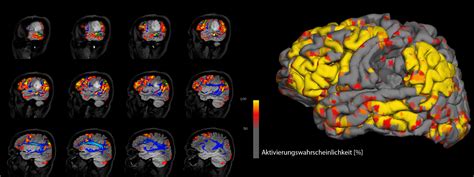 Universit Tsklinikum Heidelberg Neuroradiologie Ag Neuroimaging