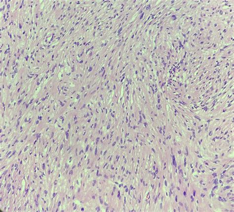 Peripheral Nerve Sheath Tumor Diagnosis Rpathology