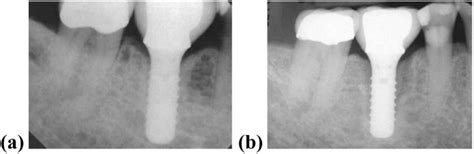 Radiographic Examination A Immediate Postoperative Radiograph