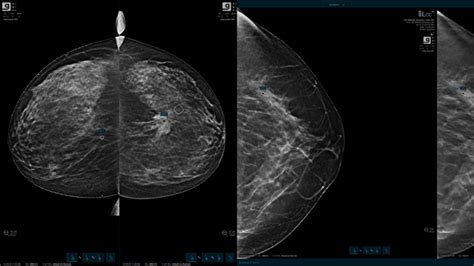 Dense Breast News For Every Boob New Fda Screening Regulations