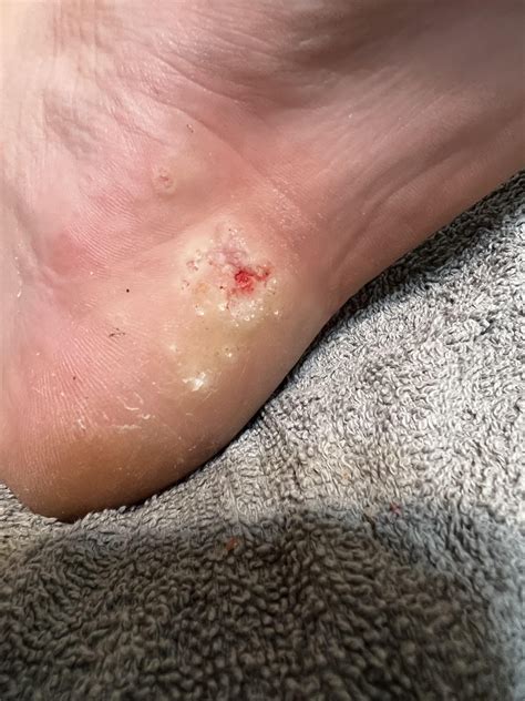 6 Yr+ plantar warts cluster - day 3 : r/Warts