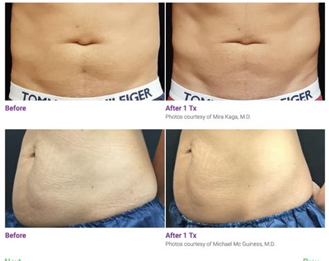 Trusculpt® 3d Delivers Results Without Surgery Glow Aesthetic Medicine