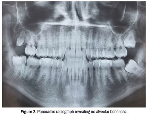 Necrotizing Ulcerative Periodontitis Radiograph