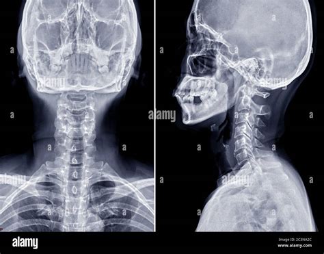 Lateral Cervical X Ray