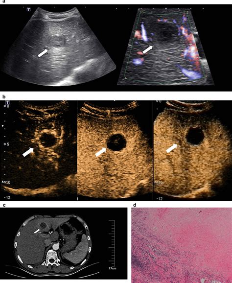 Images In A 5060 Year Old Sex 1 With A History Of Hepatocellular Download Scientific Diagram