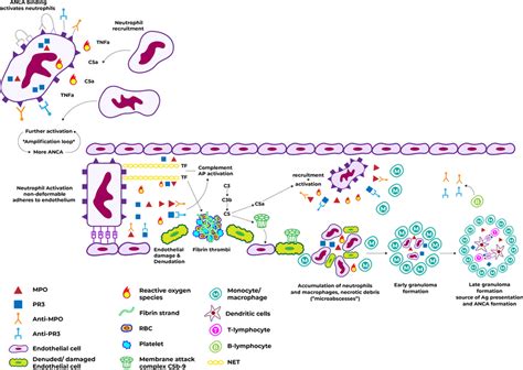 Pathogenesis Of Vascular Damage In ANCA Vasculitis Caption Binding Of