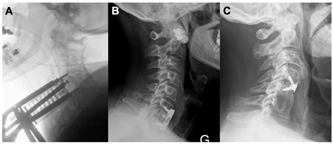 Anterior Cervical Discectomy And Fusion Length Of Surgery - Infoupdate.org