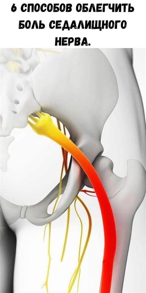 6 способов облегчить боль седалищного нерва.