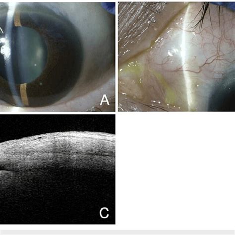 Slit Lamp A B And As Oct C Findings Three Months After The Download Scientific Diagram