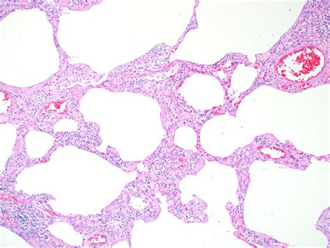 Pattern Cellular Infiltrates Patterns Of Pulmonary Pathology