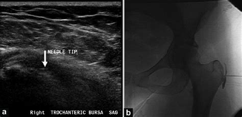 Ultrasound Guided Iliopsoas Injection