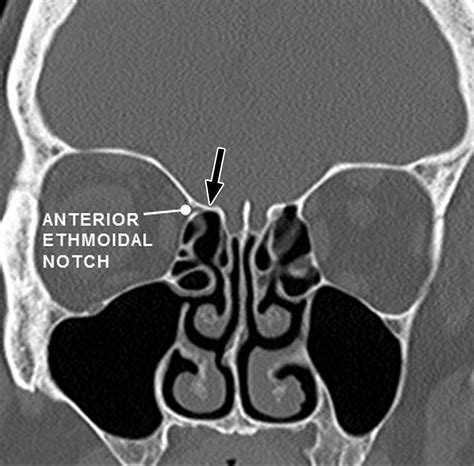 The Preoperative Sinus CT Avoiding A CLOSE Call With Surgical