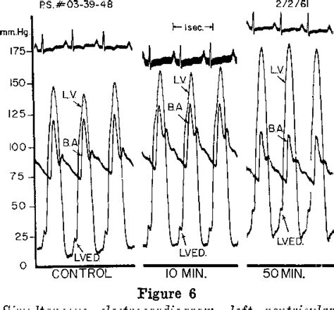 [pdf] Aortic Stenosis And Hypertrophic Subaortic Stenosis Semantic