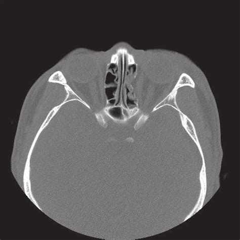 Preoperative Computed Tomography Scan Axial Views Of Preoperative