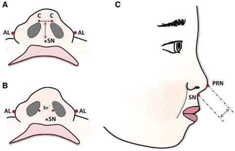 anthropometric points  nasal width columella length  columella