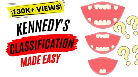 Kennedys Classification Applegates Rules Easy Youtube